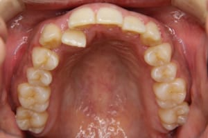 矯正歯科治療前です。右上の側切歯が口蓋側にあります。